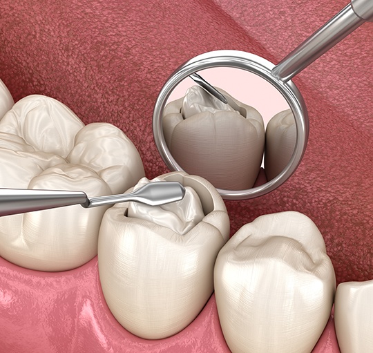 Dentist demonstrating tooth-colored filling on large model tooth