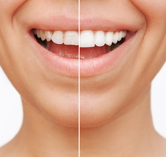 Before and after of veneers